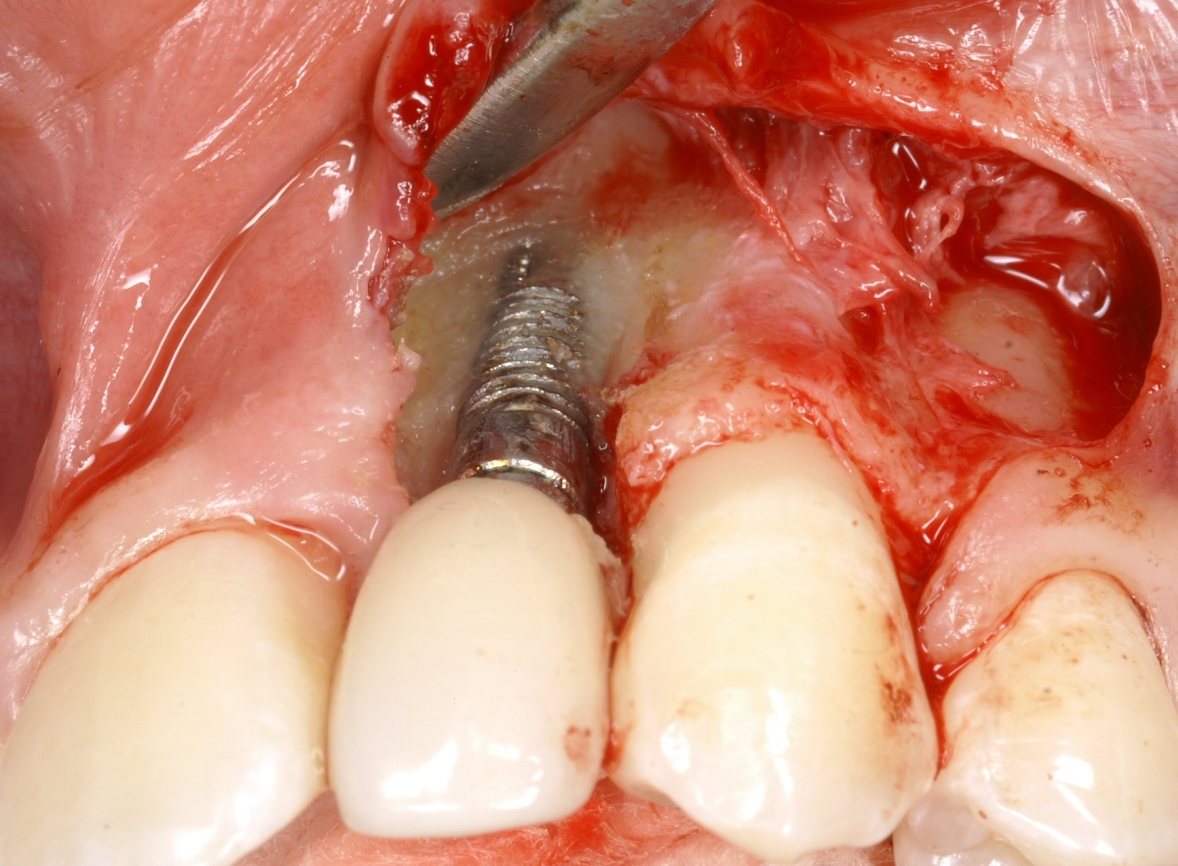 با مشاهده علائم عفونت لثه در ایمپلنت دندان چه باید کرد؟