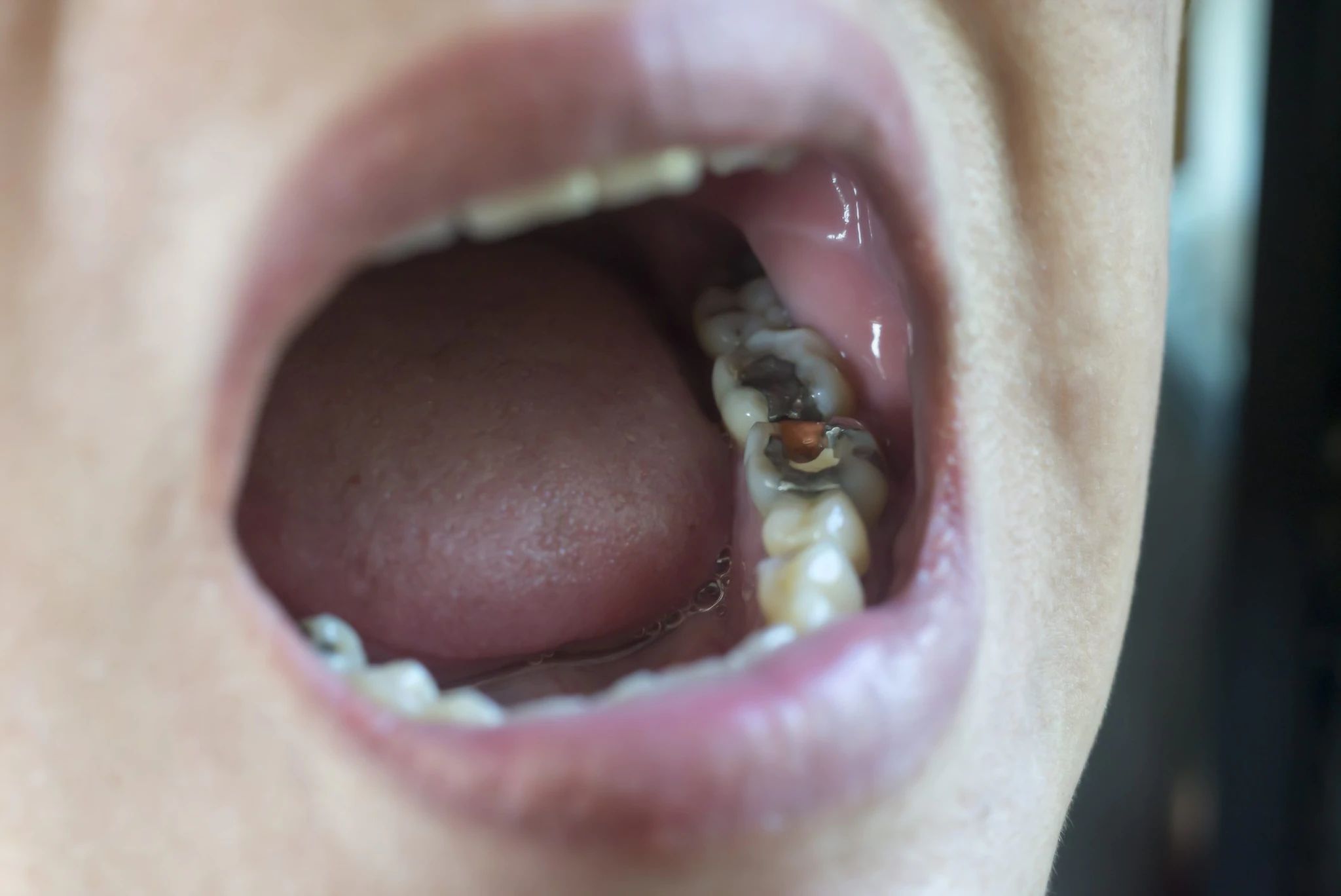 عوامل خطر مرتبط با عفونت های قارچی دهان