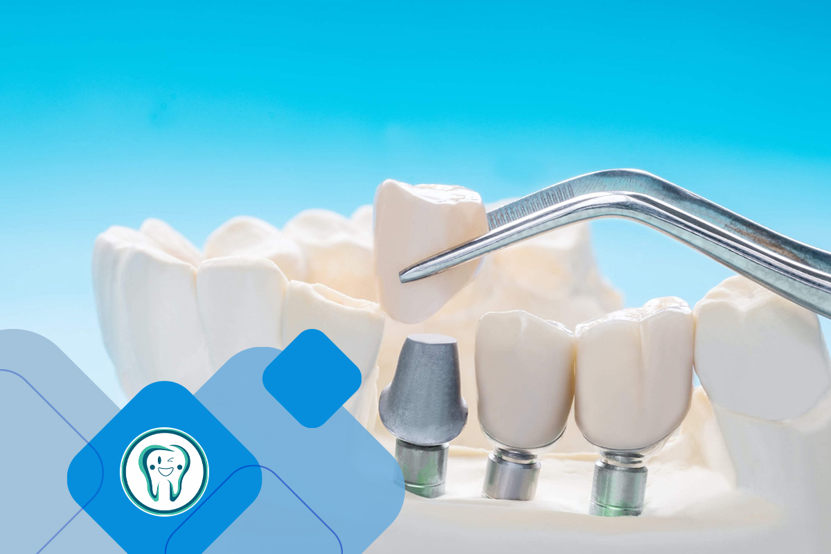 مراقبت از انواع پروتز دندان
