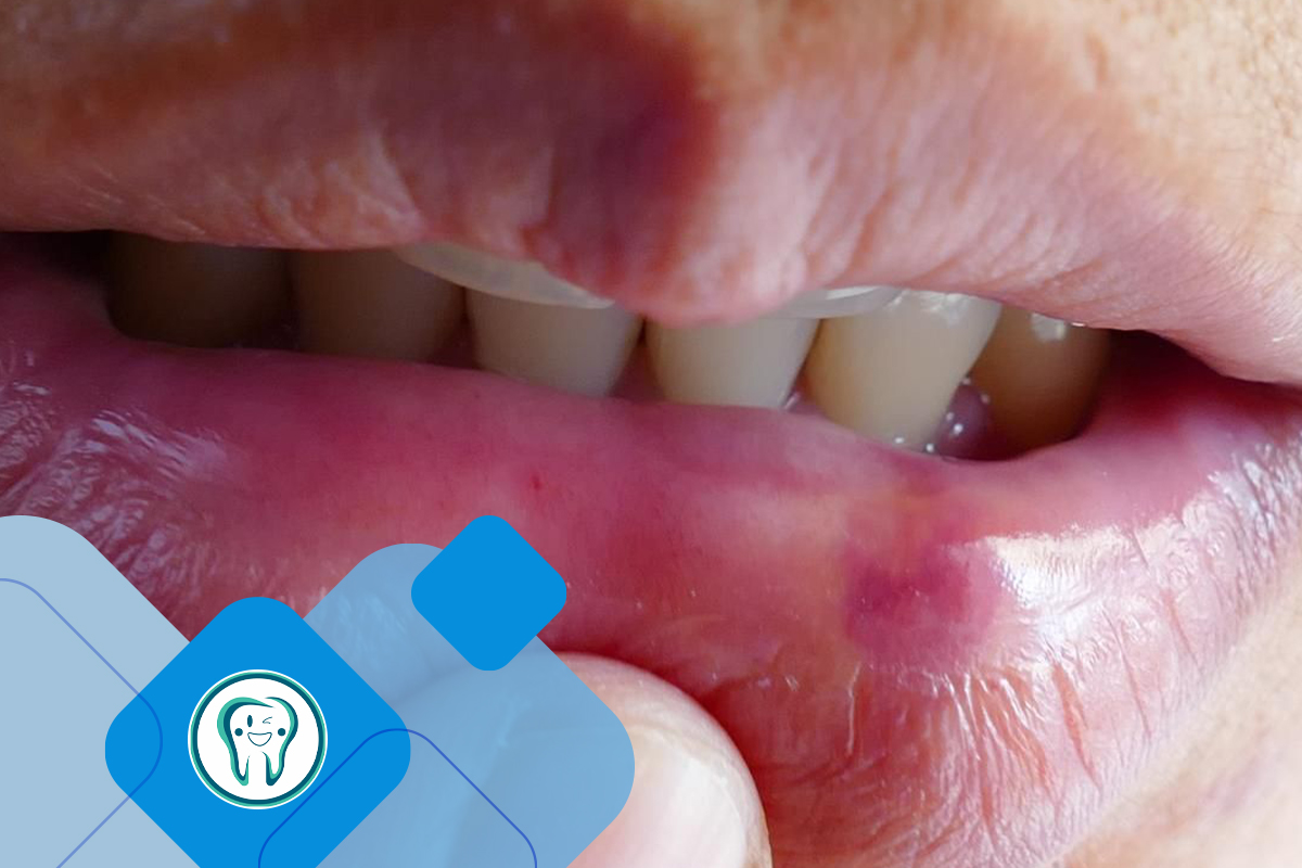 روش های درمان تاول خونی در دهان