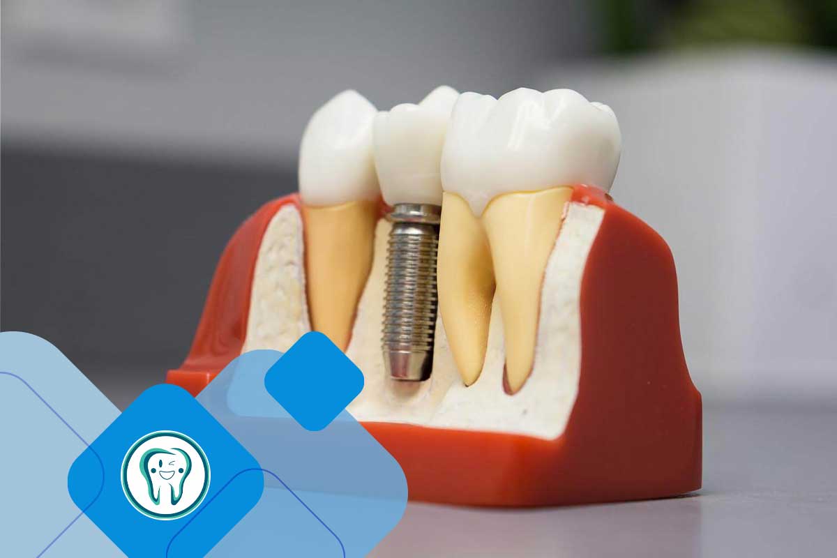 انتخاب دکتر بیاتی برای ایمپلنت دندان 