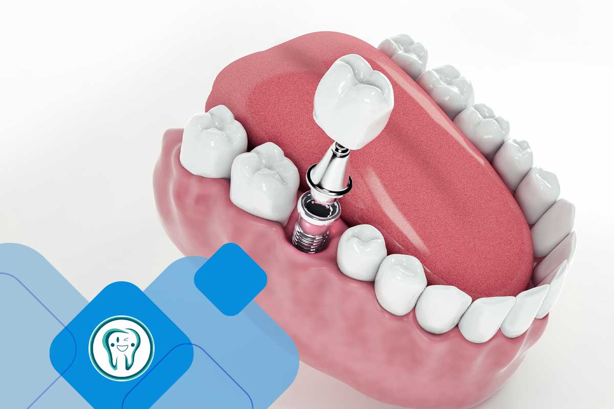 تفاوت متخصص کاشت دندان با دندانپزشک عمومی 