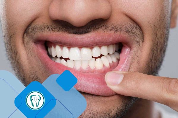 پیوند لثه در کرج