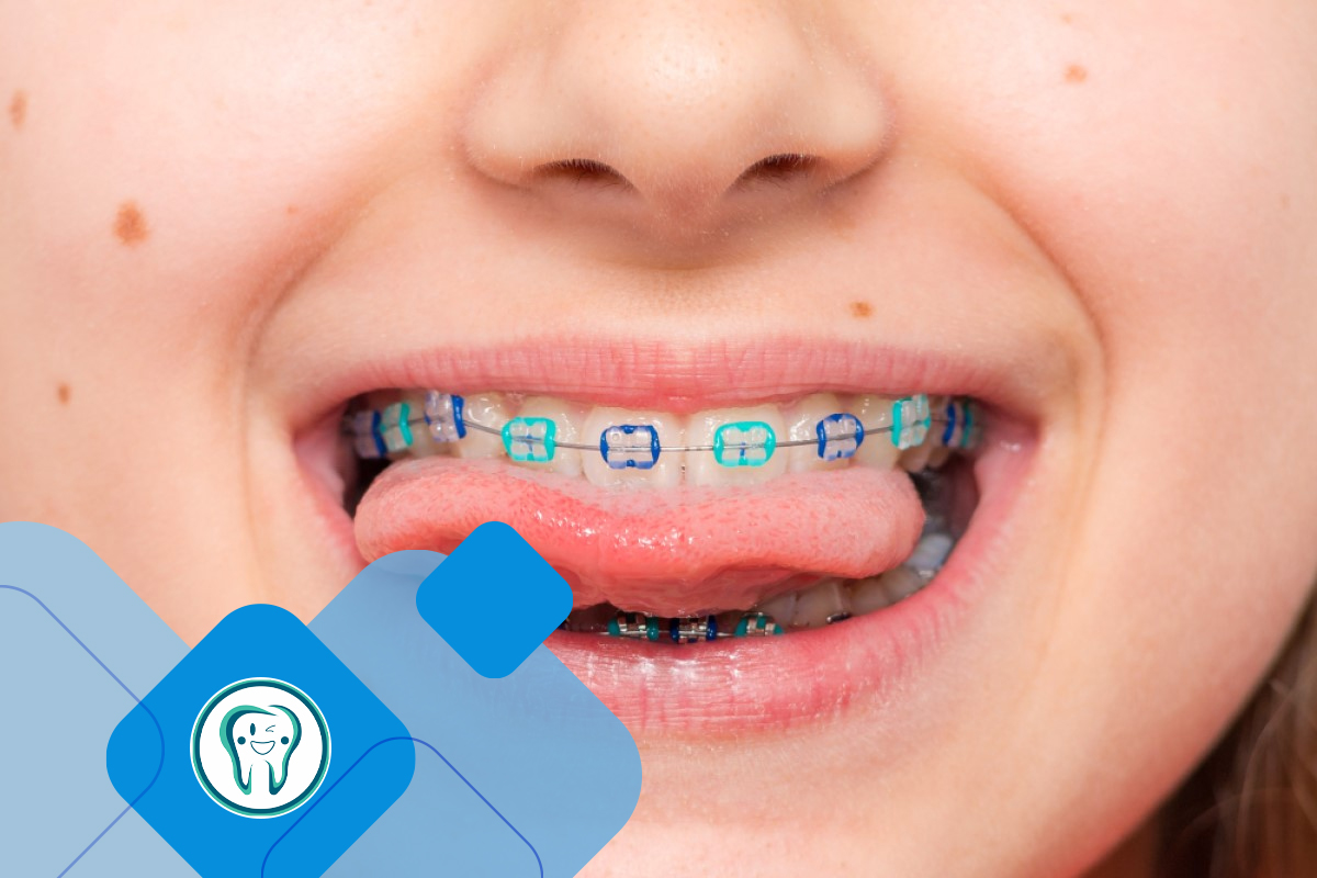 Orthodontics for childrens teeth
