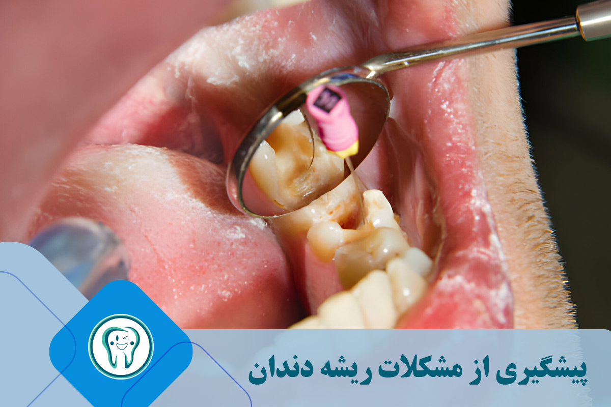 پیشگیری از مشکلات ریشه دندان