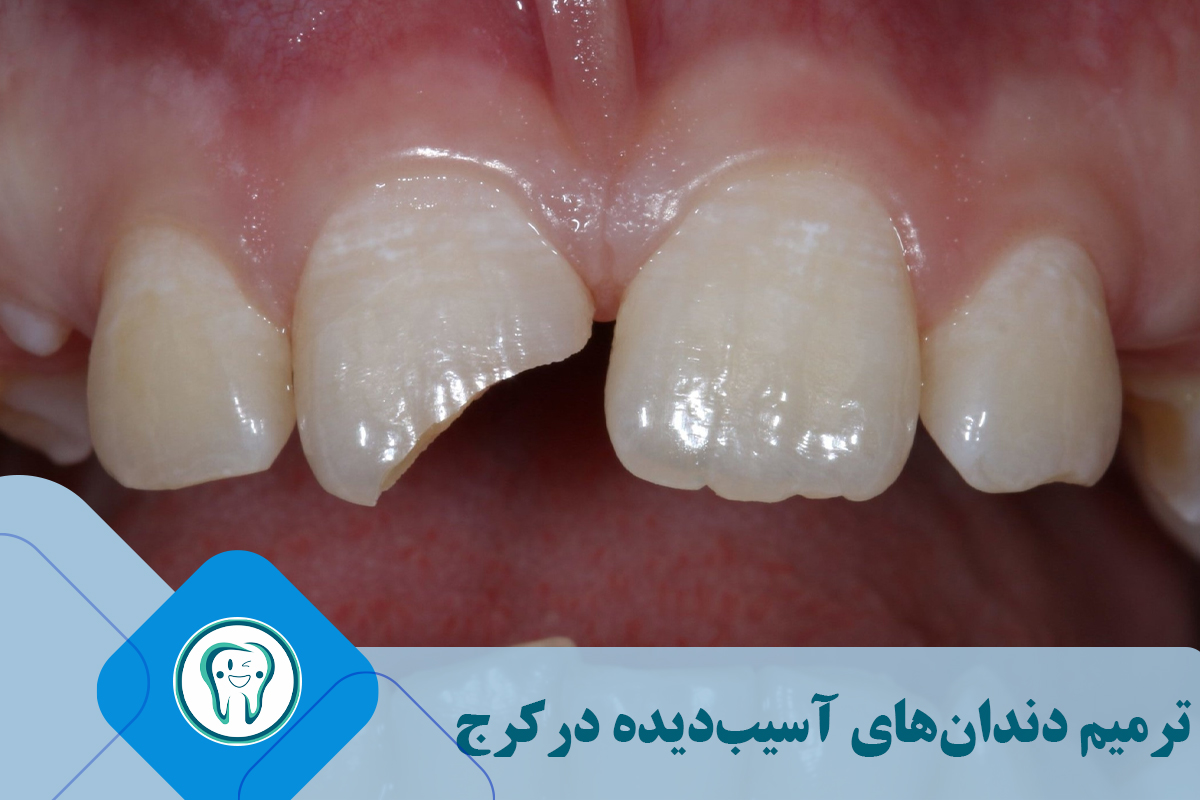 ترمیم دندان‌های آسیب‌دیده