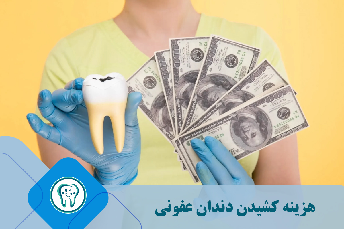 هزینه کشیدن دندان عفونی