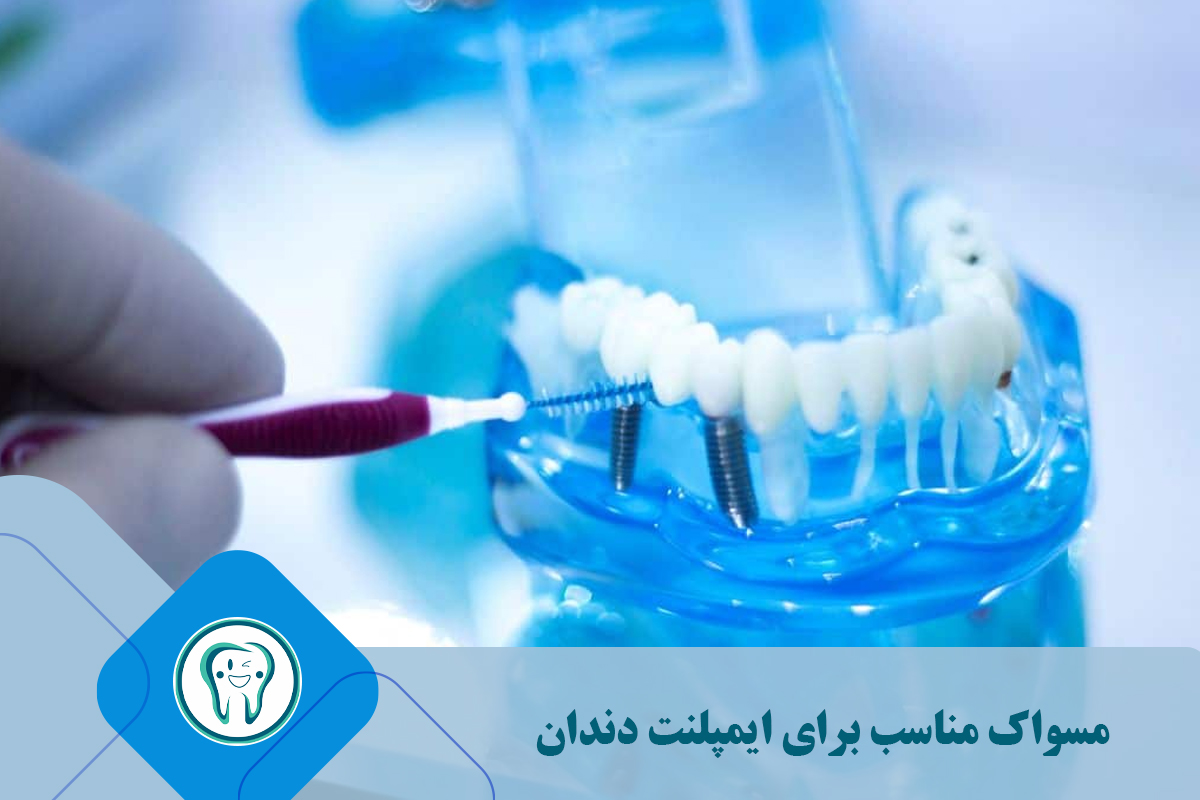 مسواک مناسب برای ایمپلنت دندان 