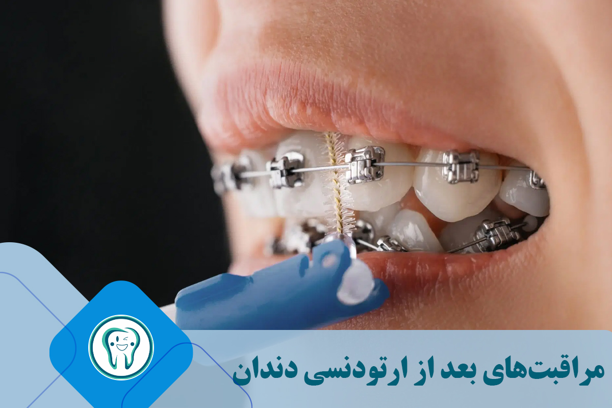 مراقبت‌های بعد از ارتودنسی دندان