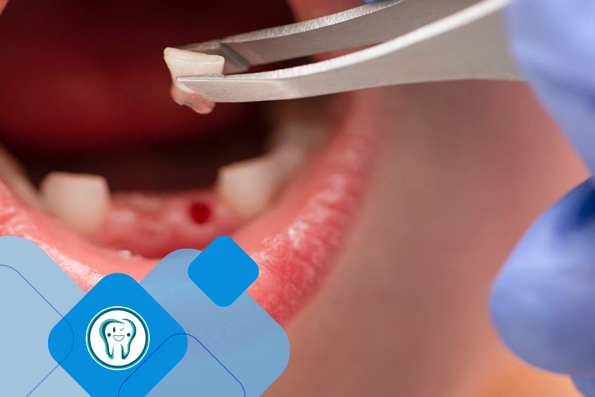 Extraction of milk teeth