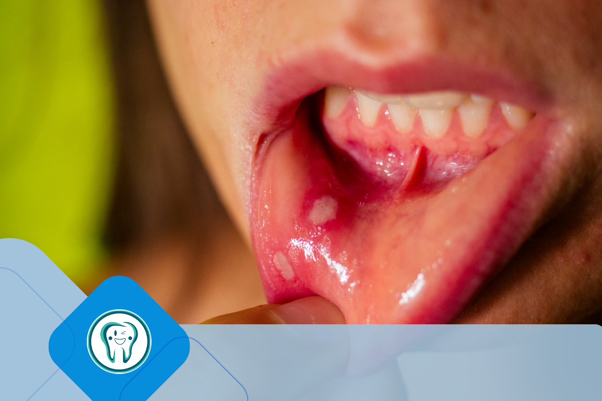 درمان آفت دهان با عسل