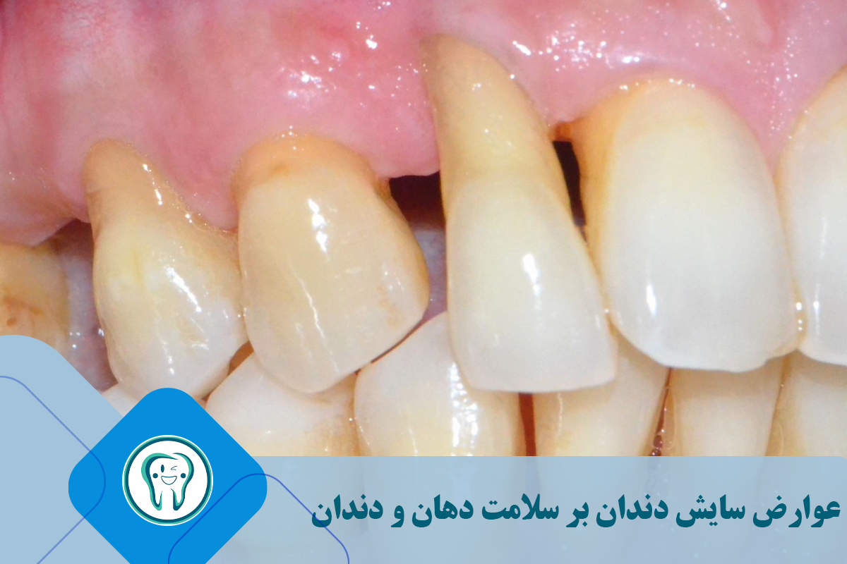 عوارض سایش دندان بر سلامت دهان و دندان