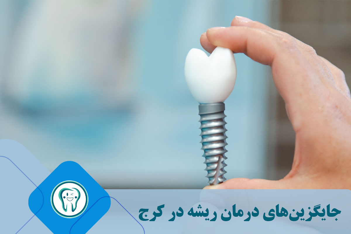 جایگزین‌های درمان ریشه در کرج