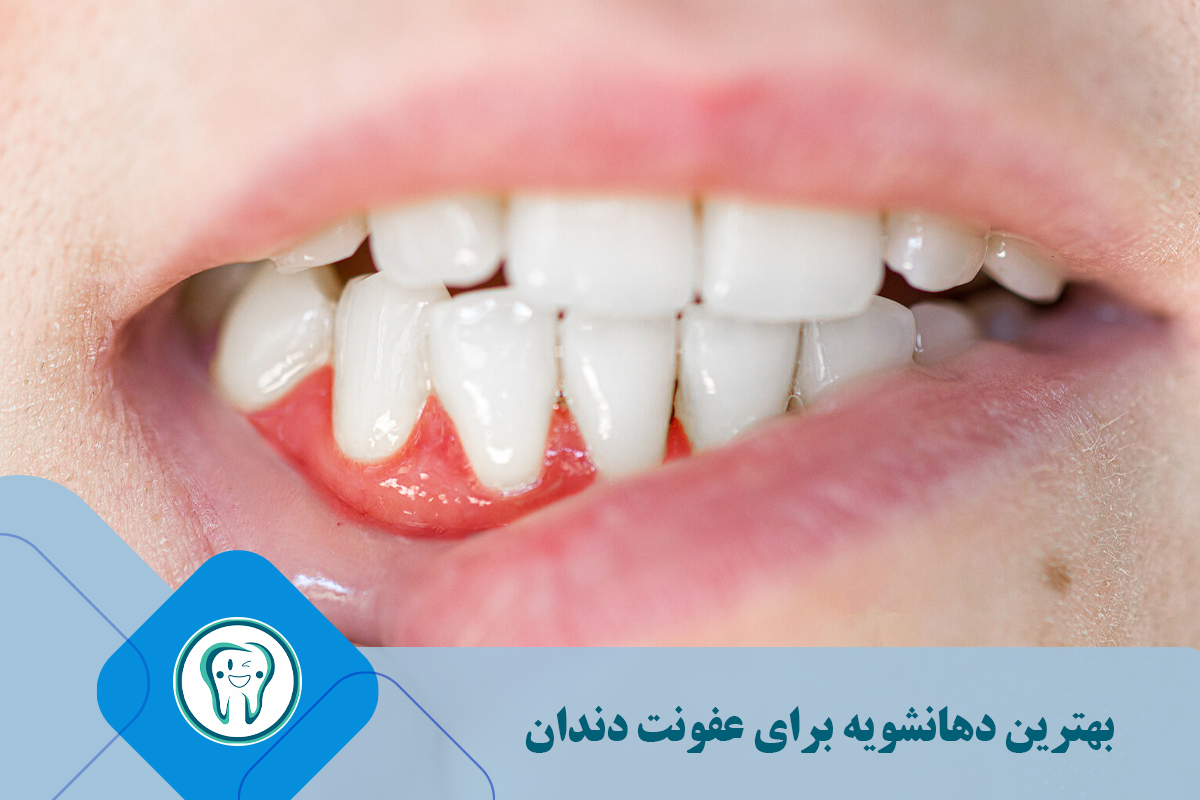 بهترین دهانشویه برای عفونت دندان