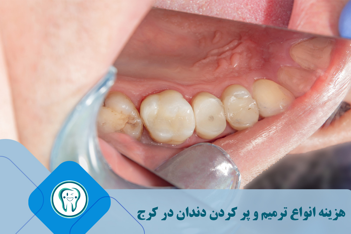 هزینه انواع ترمیم و پر کردن دندان در کرج 
