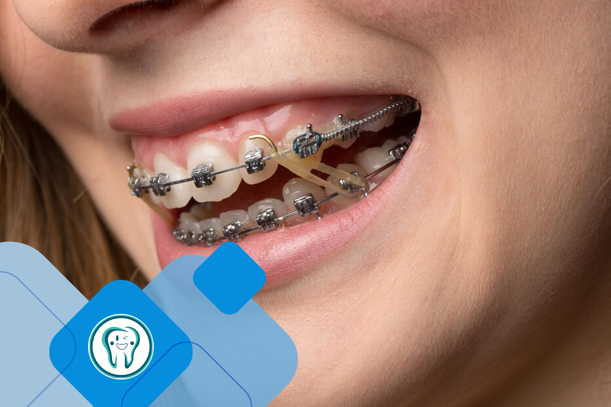 ارتودنسی برای اصلاح فک پایین جلو آمده