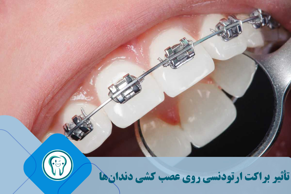 تأثیر براکت ارتودنسی روی عصب کشی دندان‌ها 