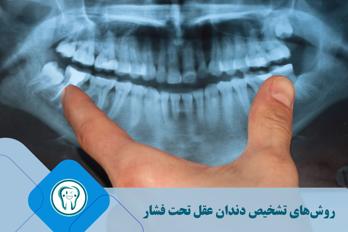 روش‌های تشخیص دندان عقل تحت فشار 