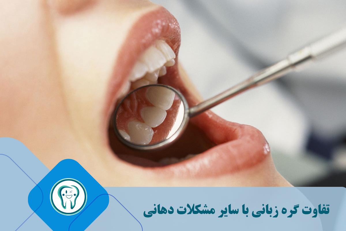 تفاوت گره زبانی با سایر مشکلات دهانی
