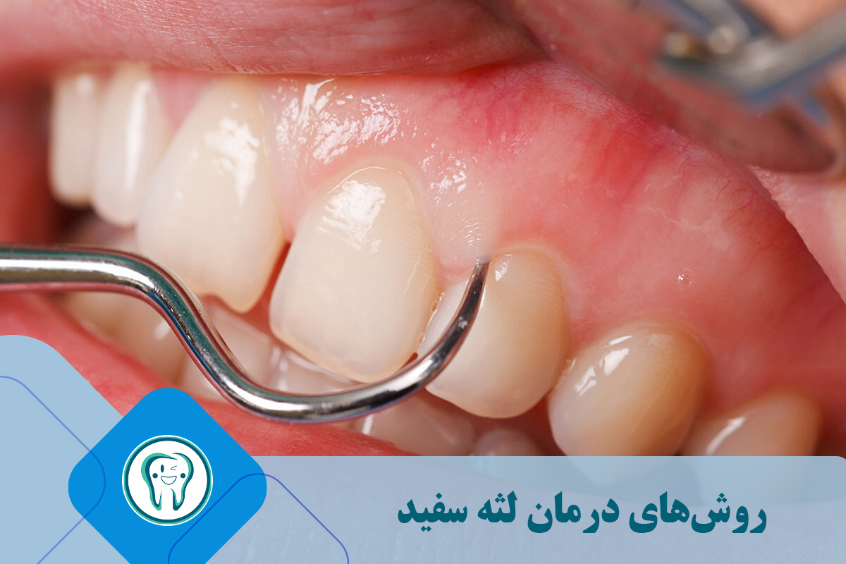 روش‌های درمان لثه سفید 