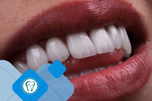 لمینت دندان در اندیشه