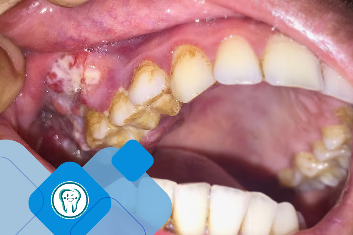 ابتلا به سرطان دهان ناشی از دخانیات