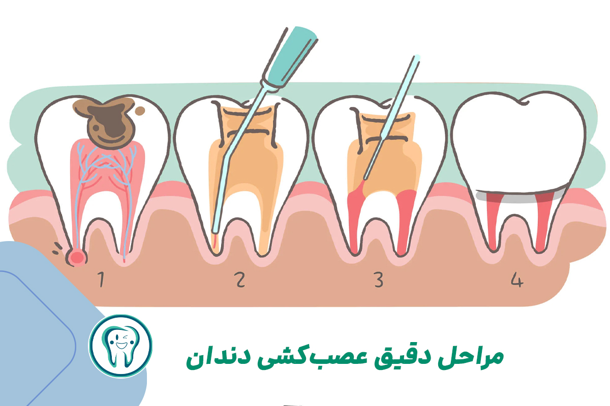 مراحل دقیق عصب‌کشی دندان 