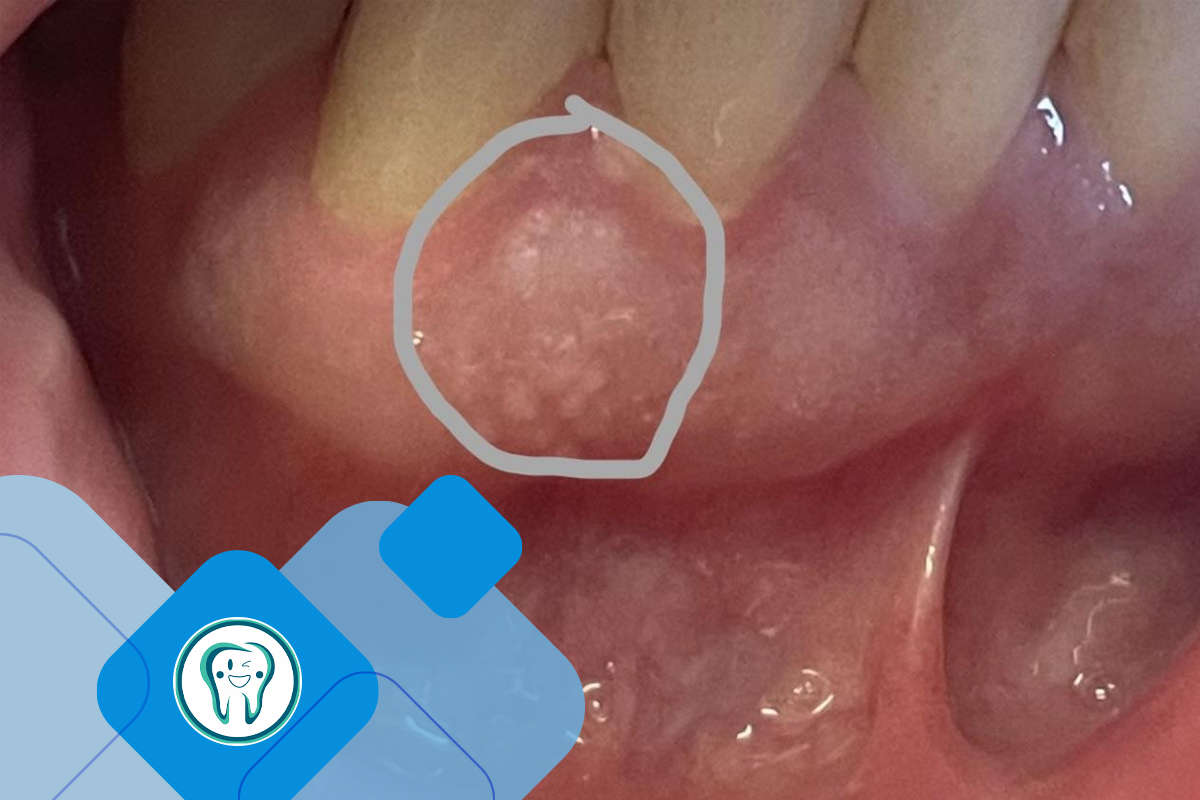 تفاوت لکوپلاکیا با نقطه سفید روی لثه