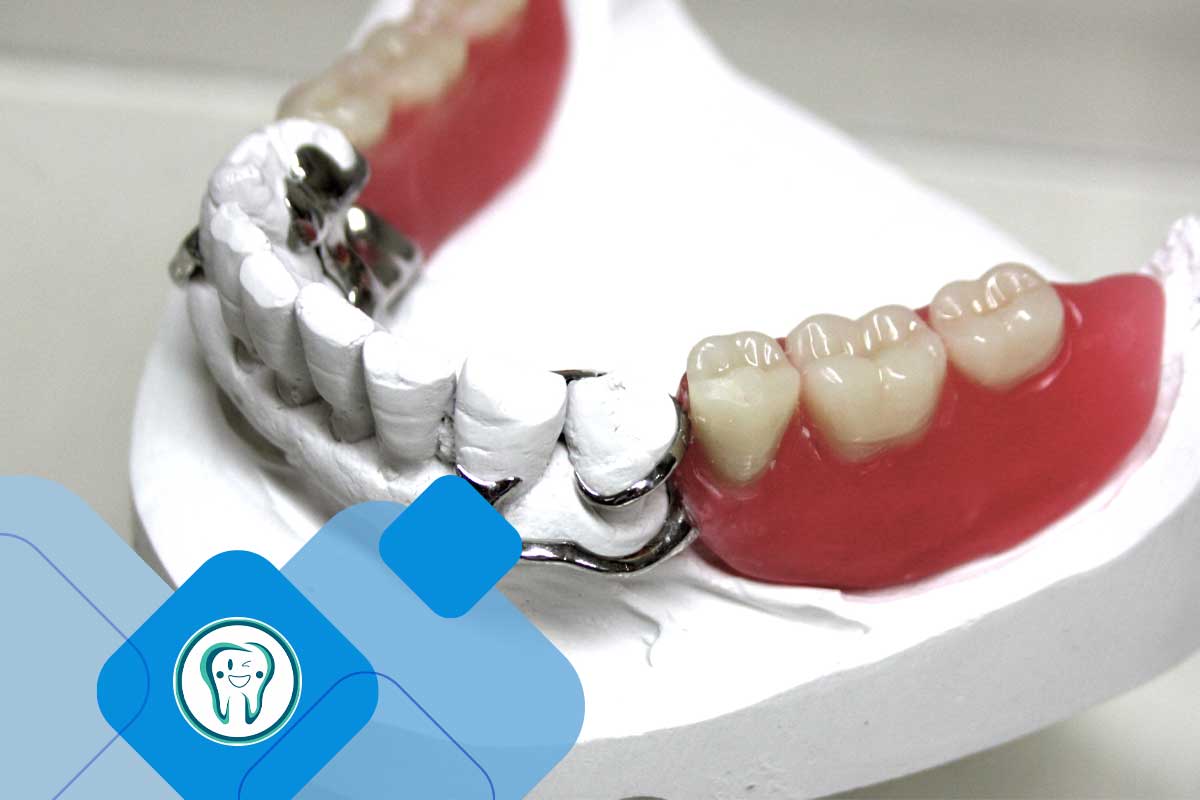 Bar overdenture with clamp