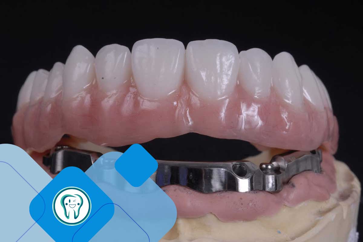 اوردنچر میله ای