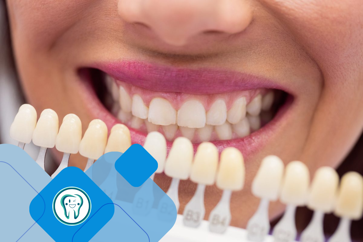 روکش کامپوزیتی دندان