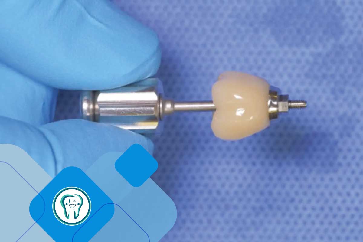 روکش موقت ایمپلنت دندان