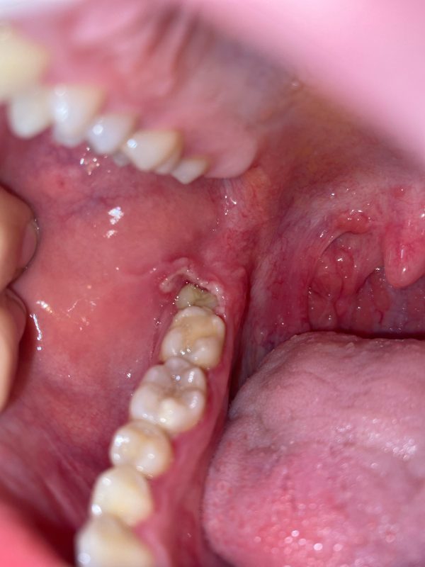 عفونت دندان