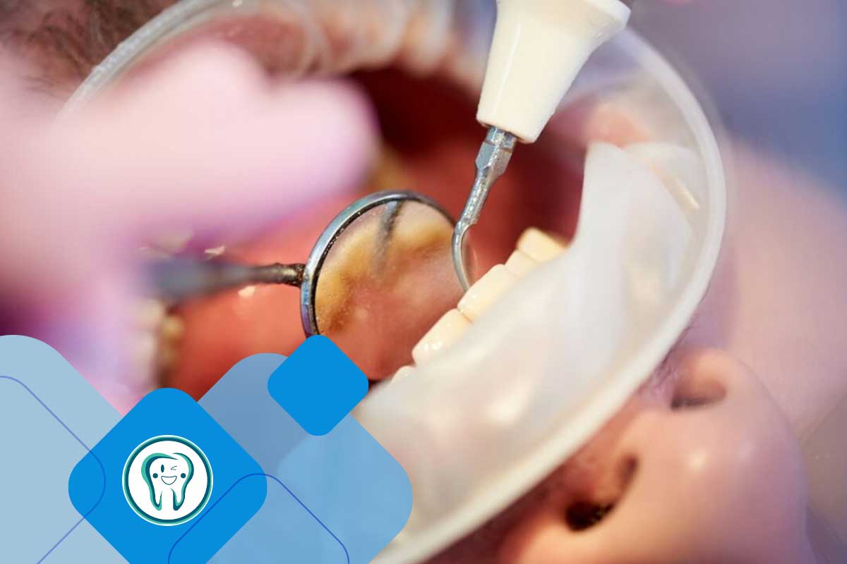 مزایا و معایب جرم گیری دندان