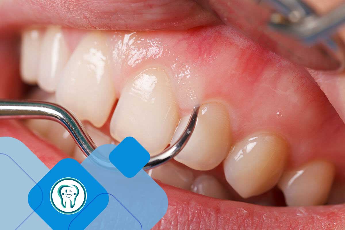 مزایا و معایب جرم گیری لثه