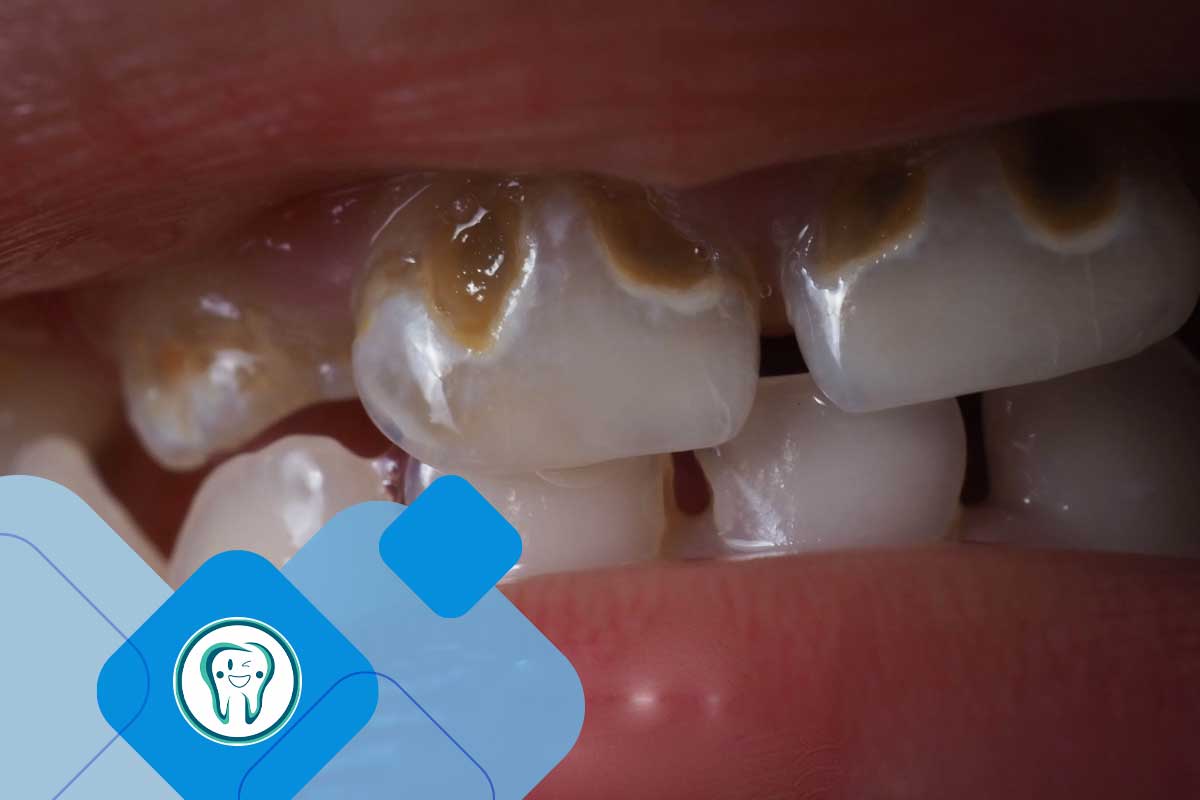 لمینت دندان برای دندان پوسیده