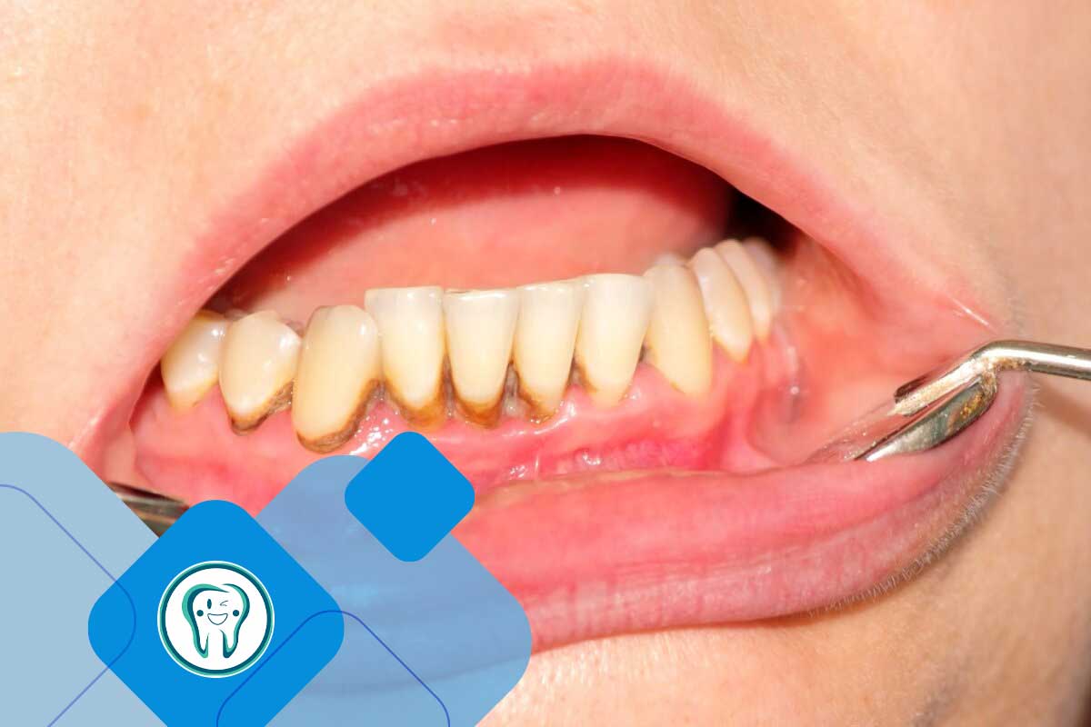 تشکیل جرم دندان