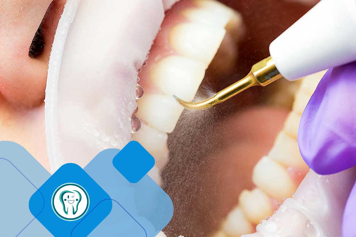 جرمگیری دندان