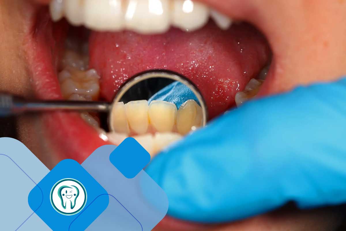 جرم‌گیری دندان
