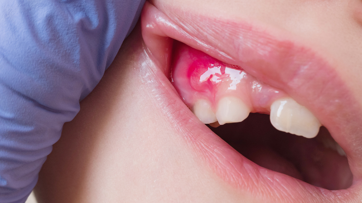 Gingivitis in children from symptoms to care heres what to