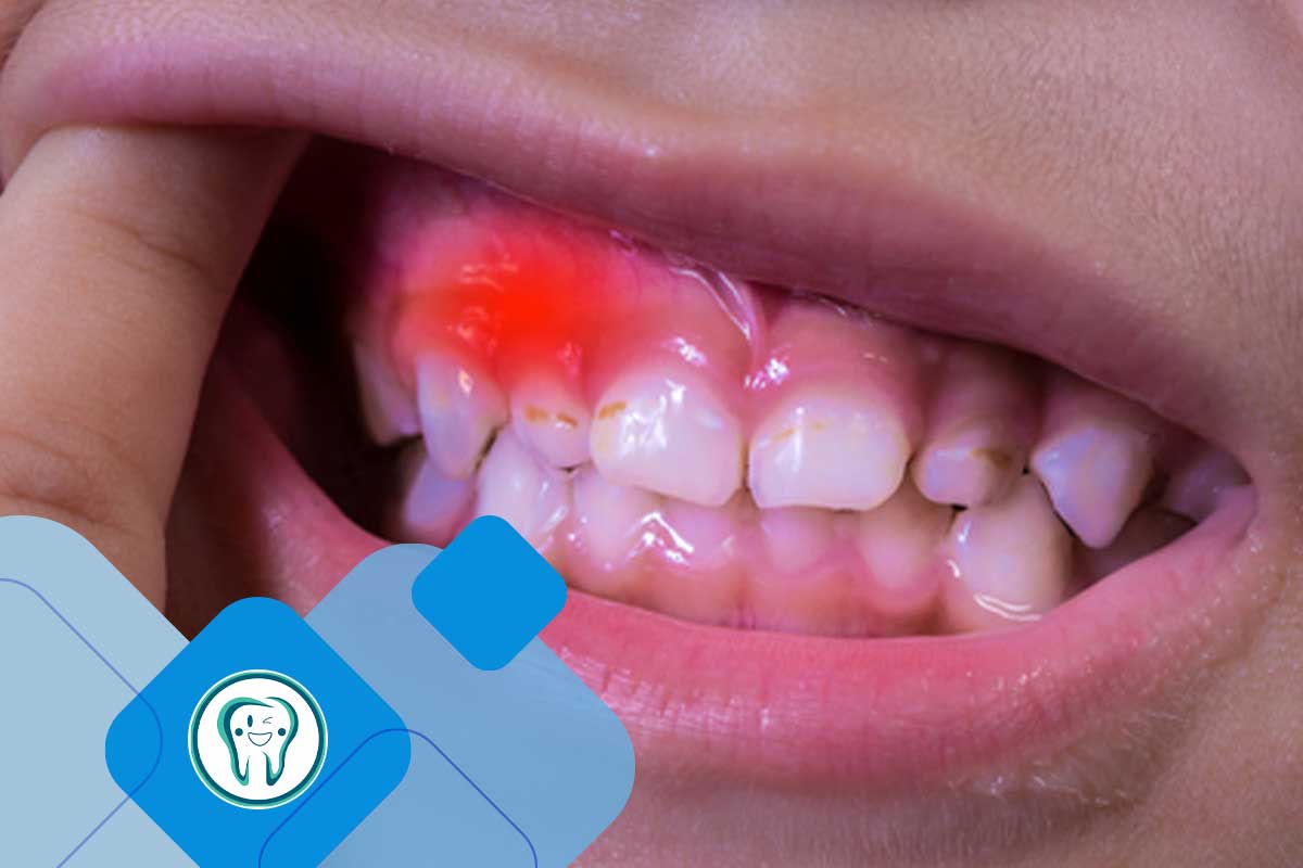 بیماری لثه در کودکان