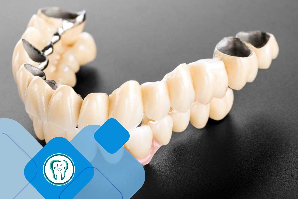 دندان موقت فوری