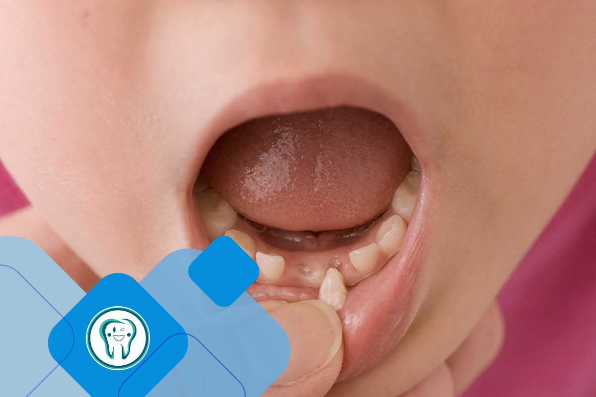 لق شدن دندان دائمی کودکان