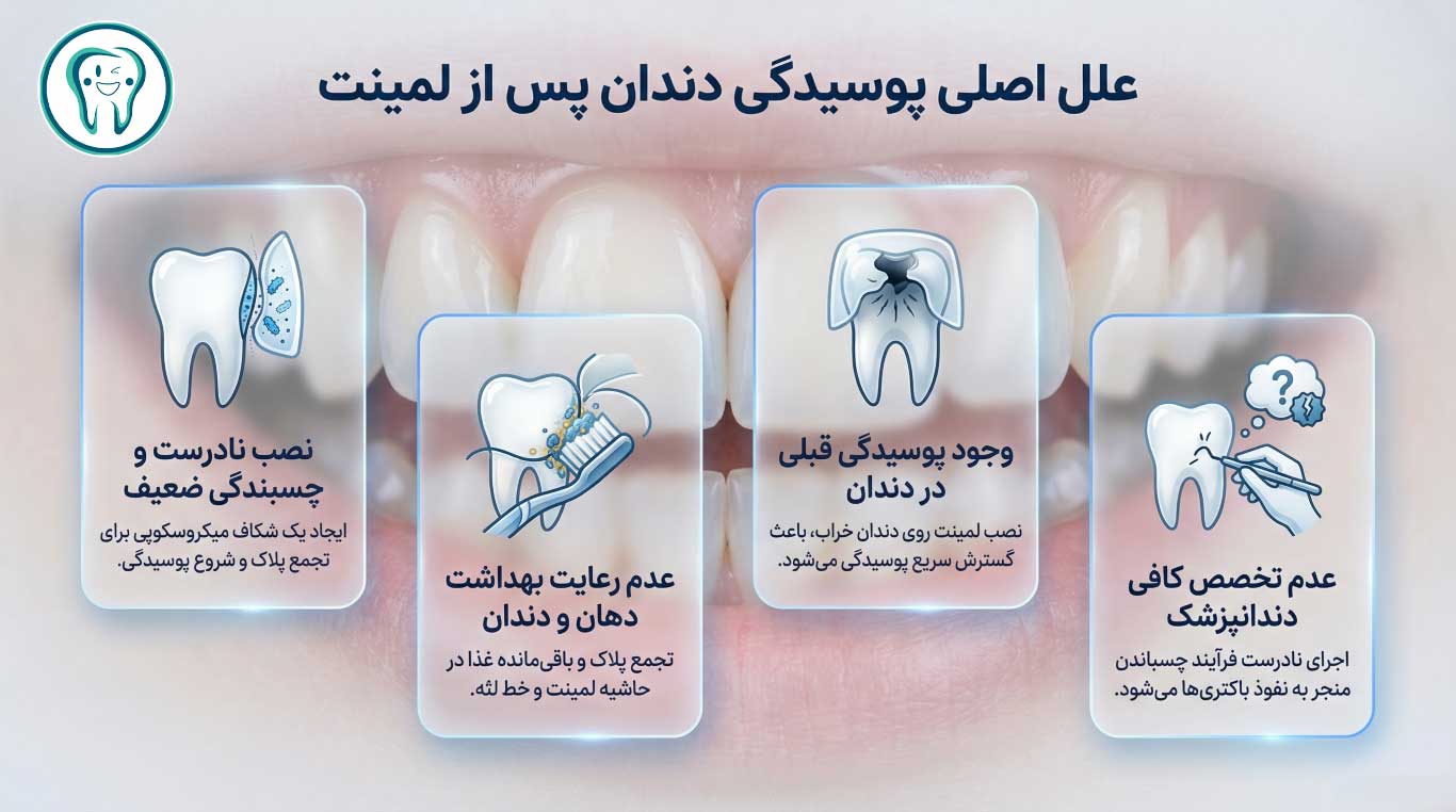 علل اصلی پوسیدگی دندان‌ها پس از نصب لمینت