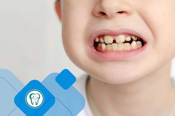 رویش دندان دائمی در کودکان