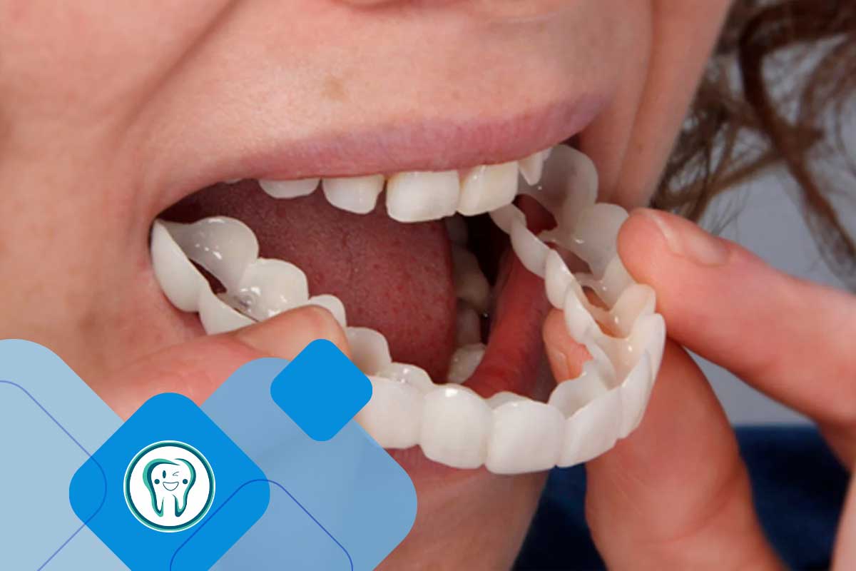 لمینت دندان متحرک 