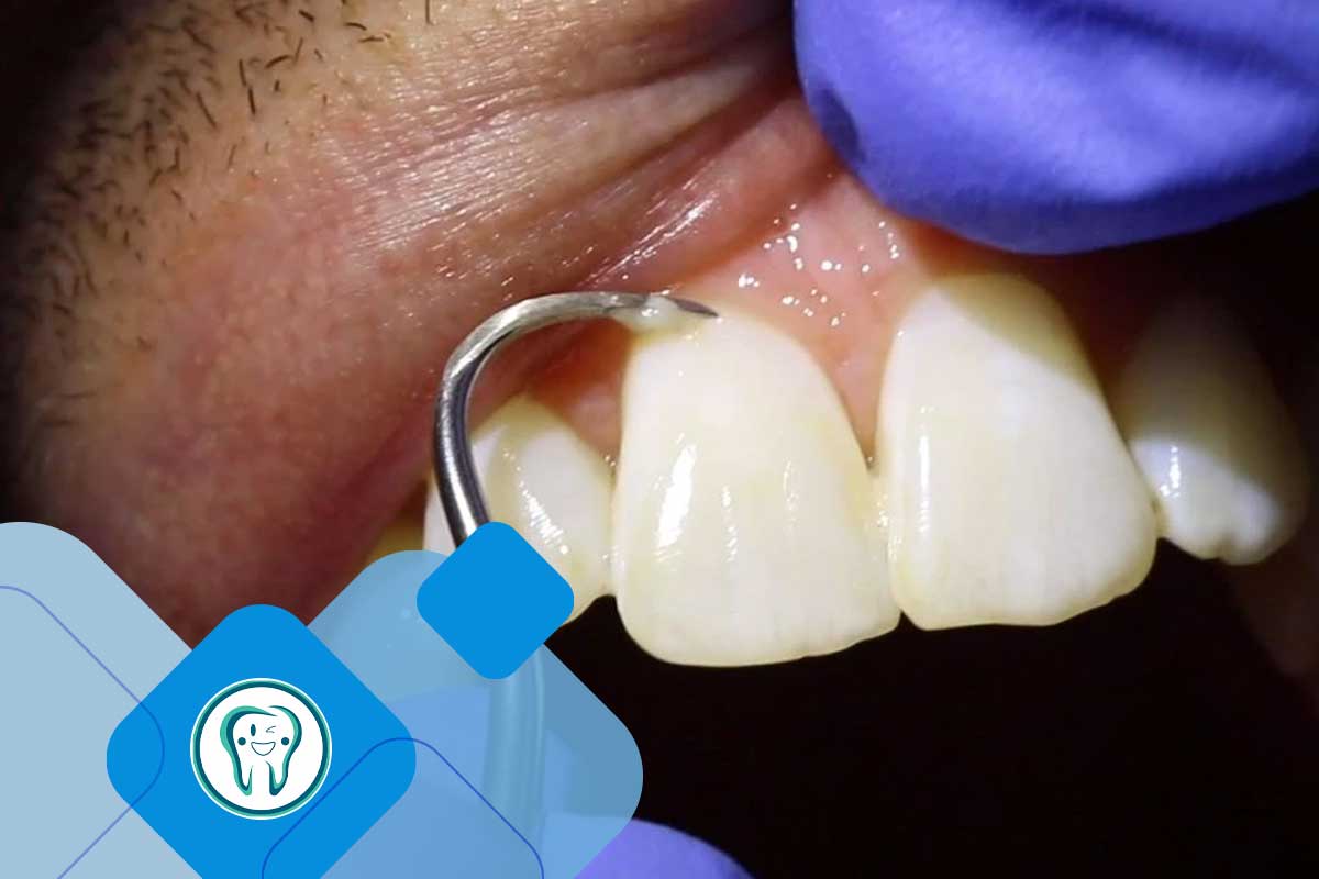 جرم‌گیری روی سطح دندان