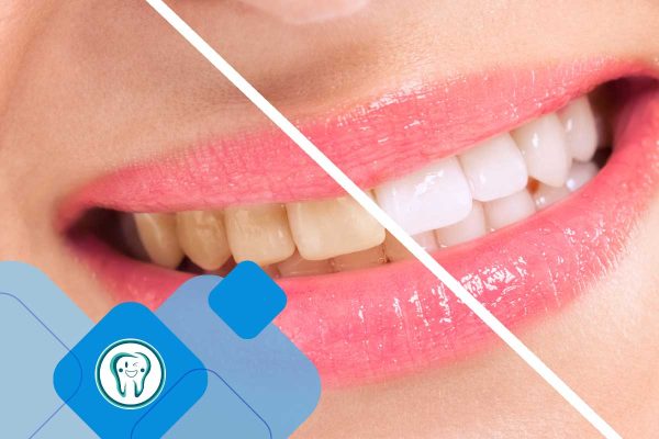 عوارض بلیچینگ دندان