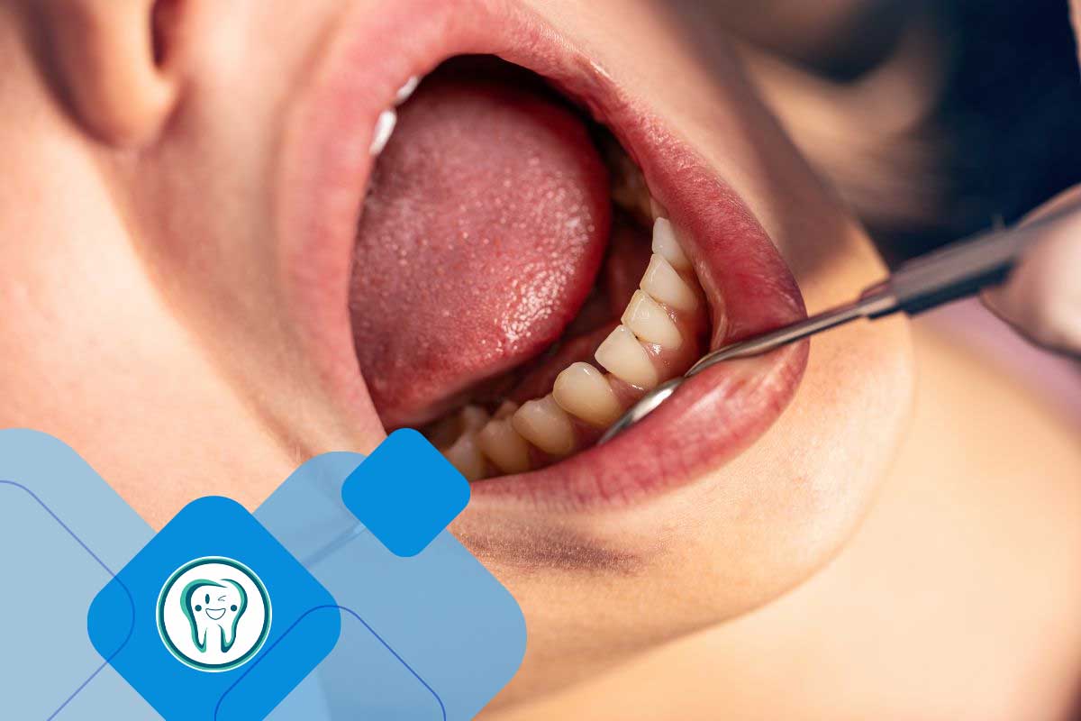 فرق جرم گیری لثه با جرمگیری دندان