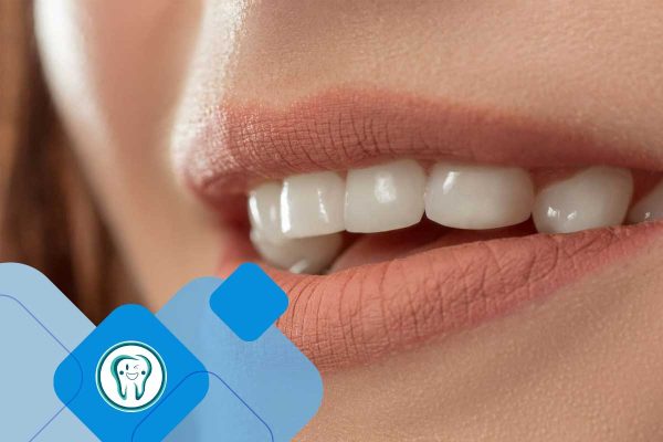 ارتباط لمینت و پوسیدگی دندان